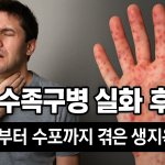 성인 수족구병